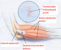 Tenisçi Dirseği